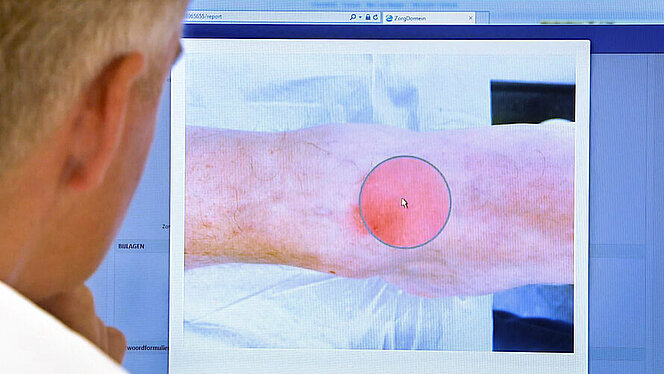 Dermatoloog beoordeelt huidaandoening op afstand voor huisarts | CWZ Nijmegen