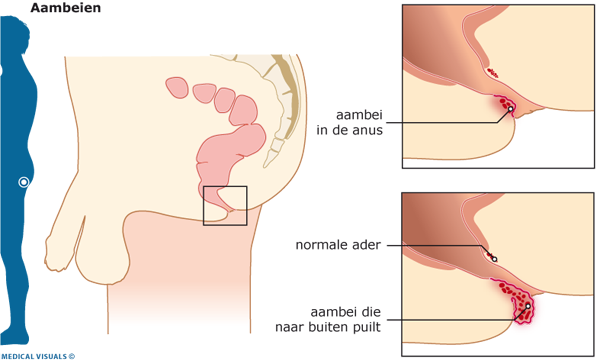 Aambeien | CWZ Nijmegen