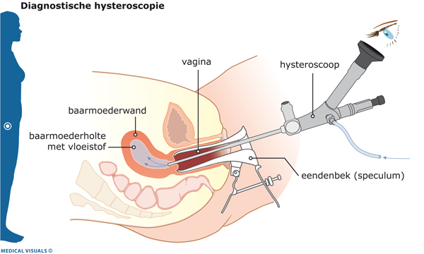 Diagnostische hysteroscopie | CWZ Nijmegen