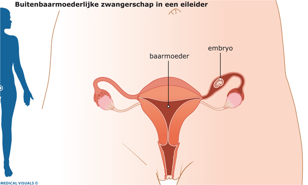Buitenbaarmoederlijke zwangerschap | CWZ Nijmegen