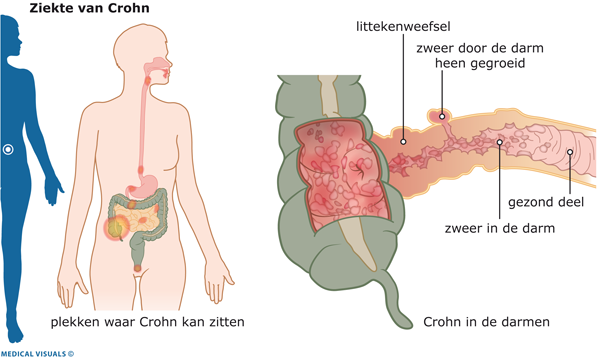 Ziekte van Crohn | CWZ Nijmegen
