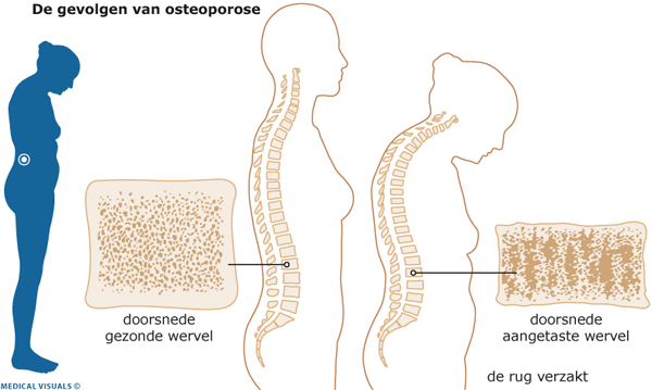 Botontkalking (osteoporose) | CWZ Nijmegen